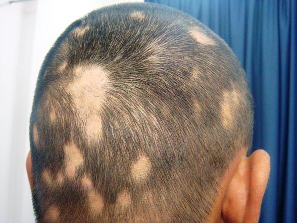 Alopecia areata hos barn