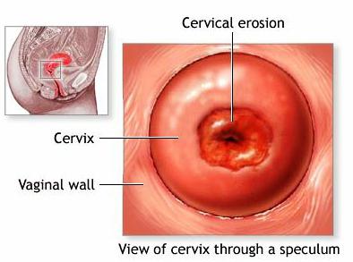 Kan jag bli gravid med cervikal erosion?