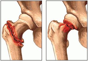 fraktur i femoral halsen hos äldre