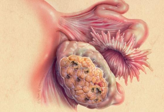 orsaker till sönderfallande ovariecyster 
