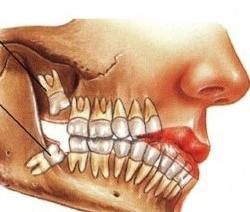 Tanden är skuren: symptom och egenskaper