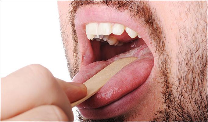 Symtom på kronisk tonsillit, dess förebyggande och behandling