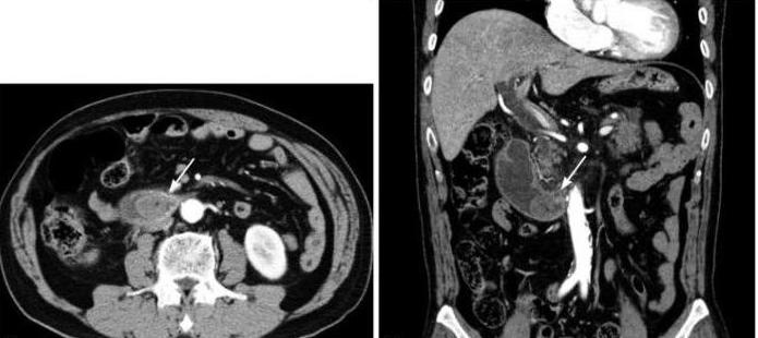 Syndrom av den resulterande slingan: diagnos och behandling