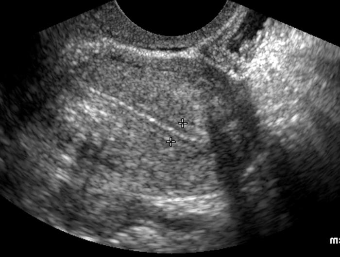 endometrial norm