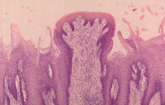 inflammation av papillorna på tungan